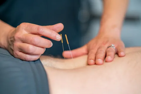 Dry needling therapy treatment